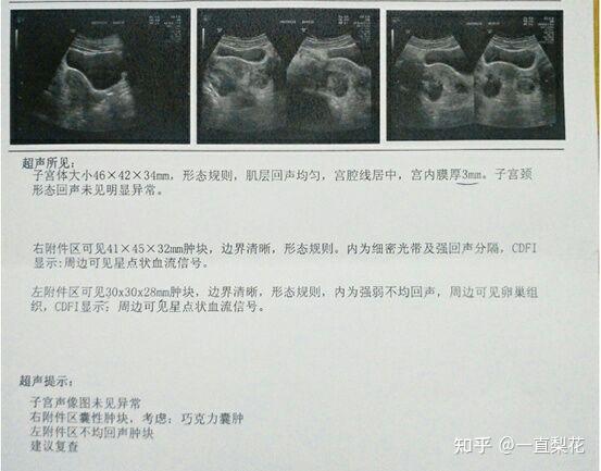 我的巧克力囊腫消失了