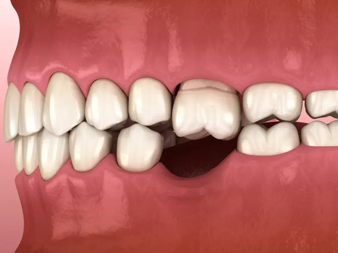 而与缺牙有咬合关系的牙齿,咀嚼时因为没有牙齿支撑,也会越变越长
