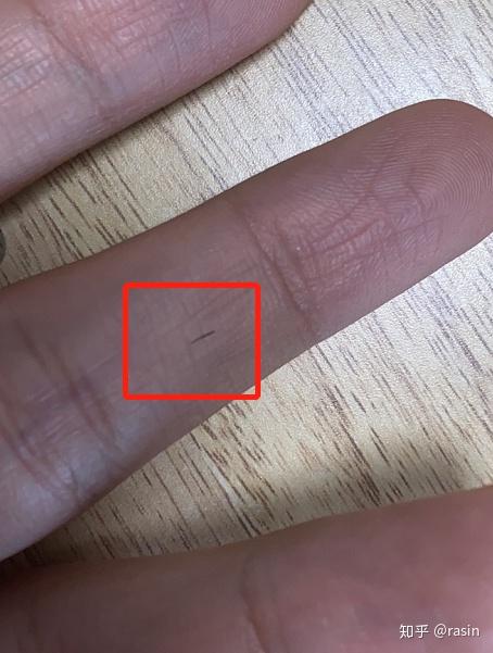 一个头发碴子扎进手指怎么办