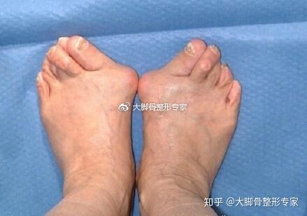 大脚骨拇指外翻的畸变原因及矫正方法