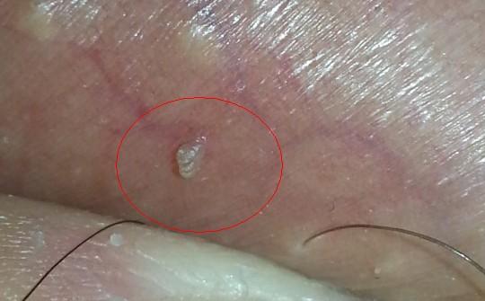 睾丸表皮凸起的小肉粒