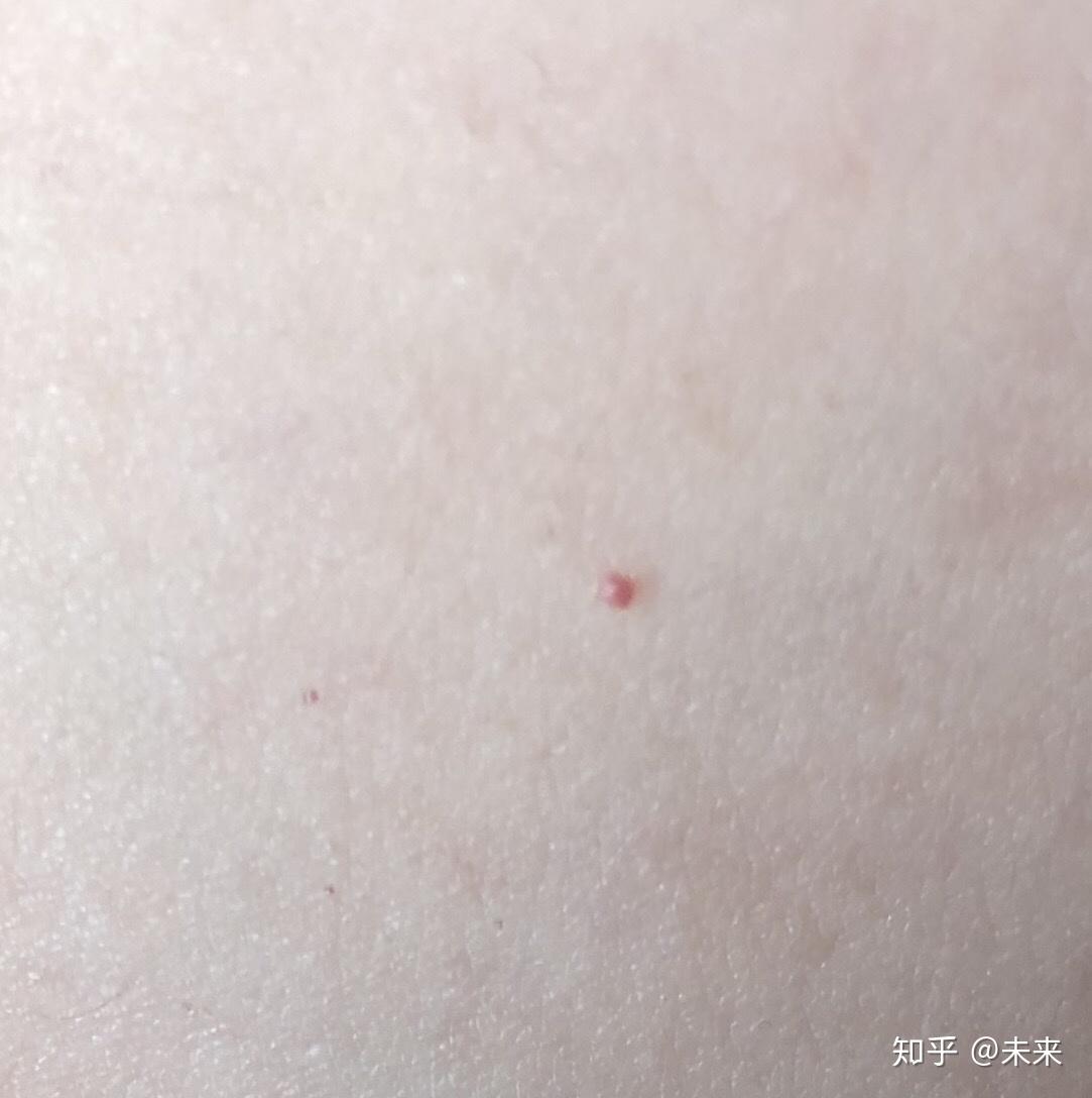 身上长有些小红点，还有的是水泡很痒不知是什么 皮肤起小红点小水泡发痒是什么病？