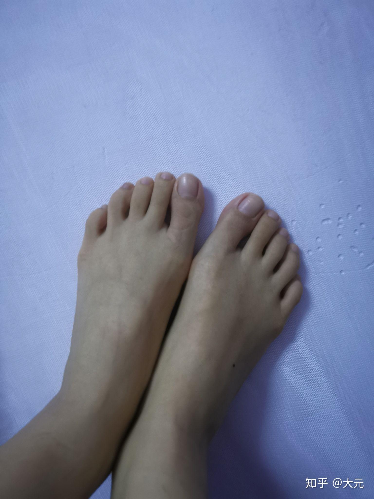 女生脚趾拇外翻是什么样体验