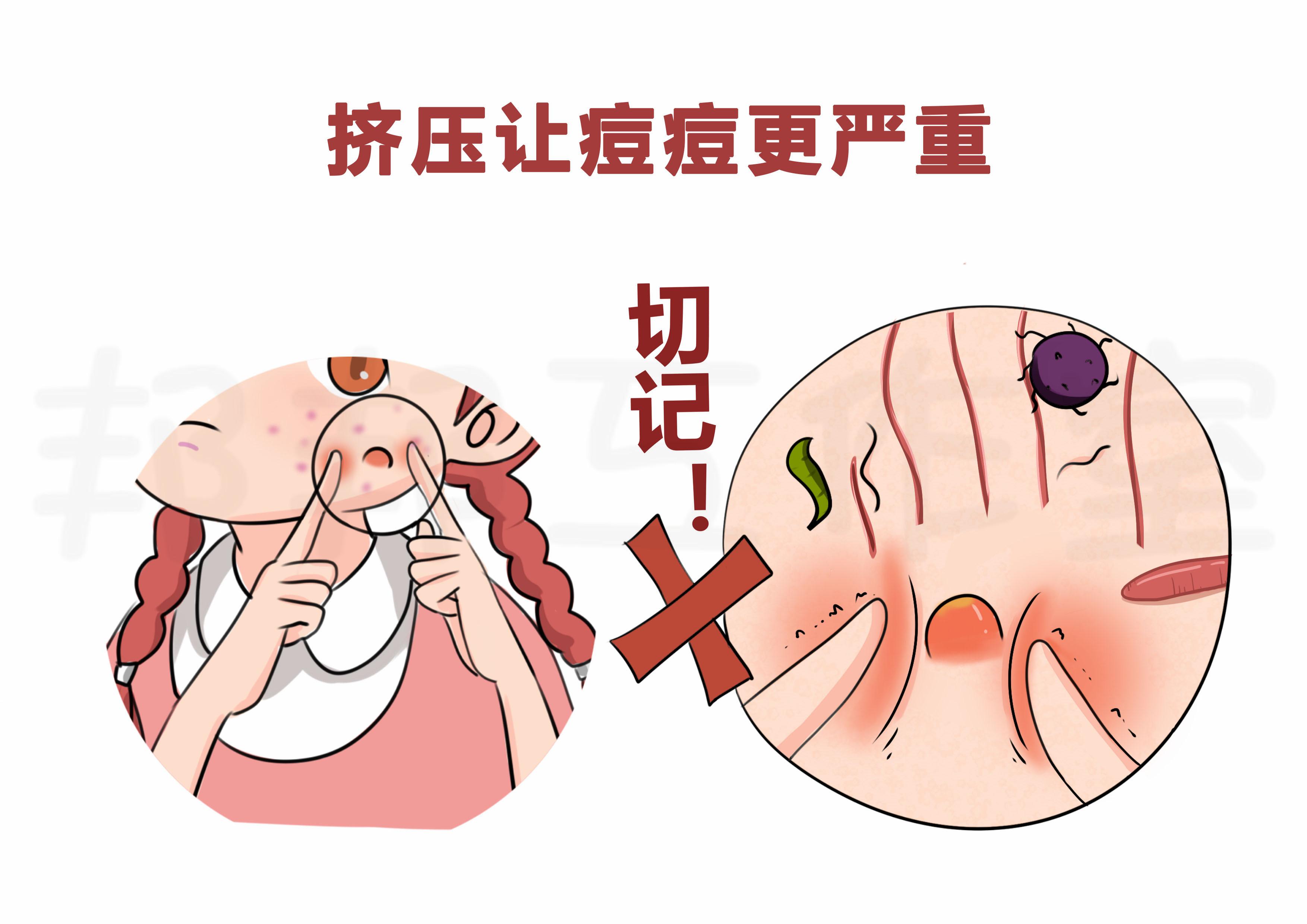 痤疮治疗常见误区