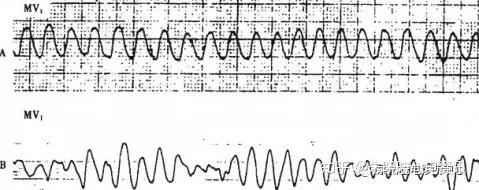室颤室扑心电图特点图片