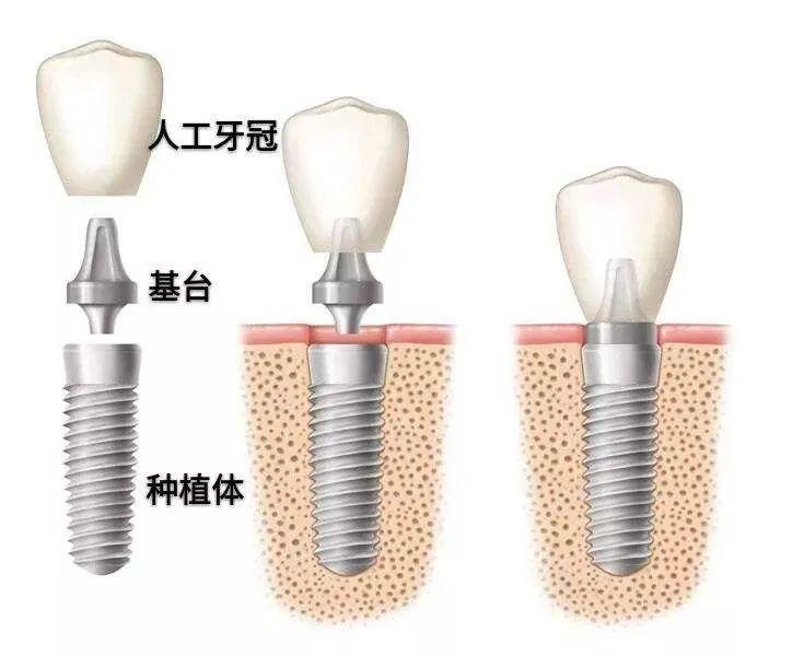 种植牙三期图解图片