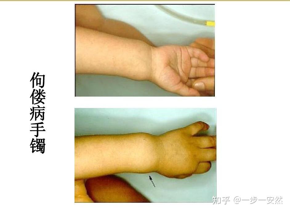 婴儿佝偻病有哪些病因?