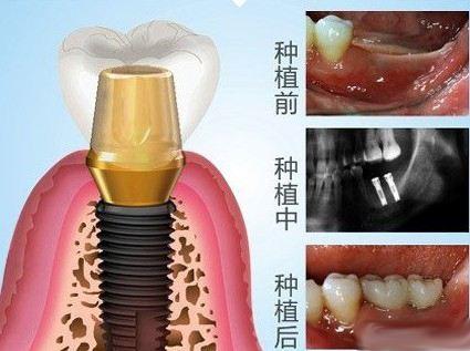 瞭解下種植牙 什麼是種植牙 種植牙簡單的說就是將一種純鈦