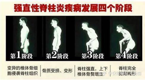 重疾险问题强直性脊柱炎患者是否符合条件