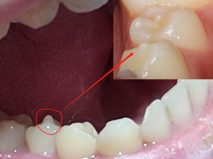 干涉,畸形中央咬硬物折断,导致牙髓暴露坏死,进而发展成慢性根尖炎症