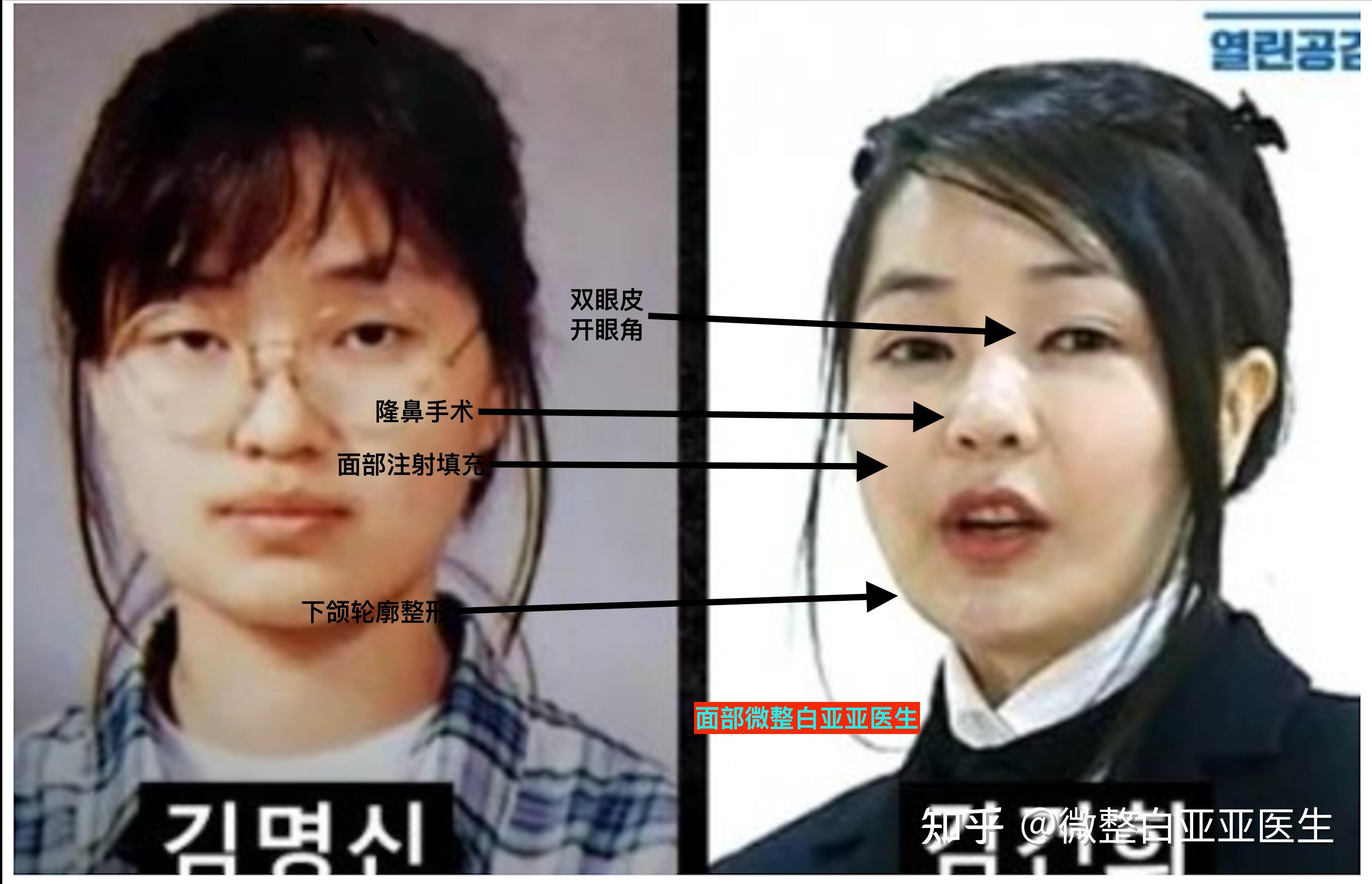 韩国第一夫人金建希整容分析 - 知乎