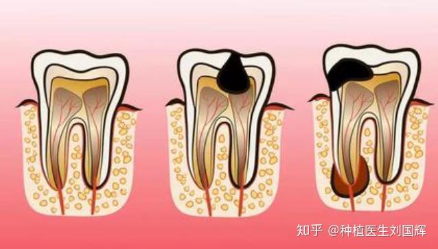 根尖周炎该怎么治疗？任由它发展下去会有什么后果？ - 知乎