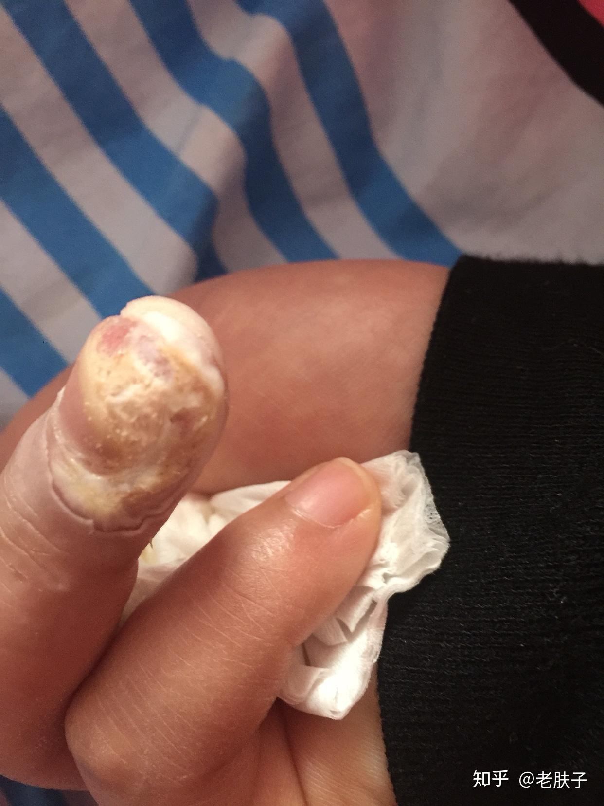 甲周疣侵蚀指甲怎么办