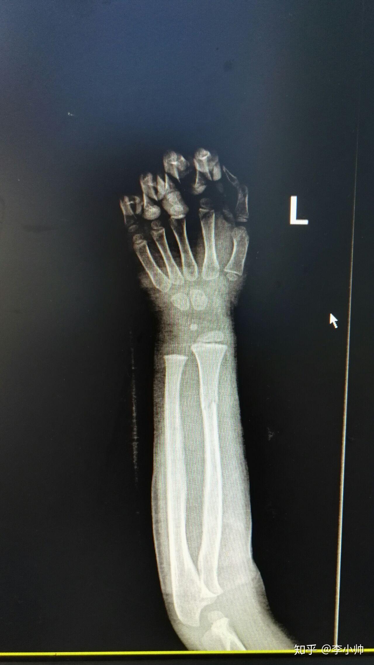 你们单位的四肢骨折传统手法复位能精准到什么程度