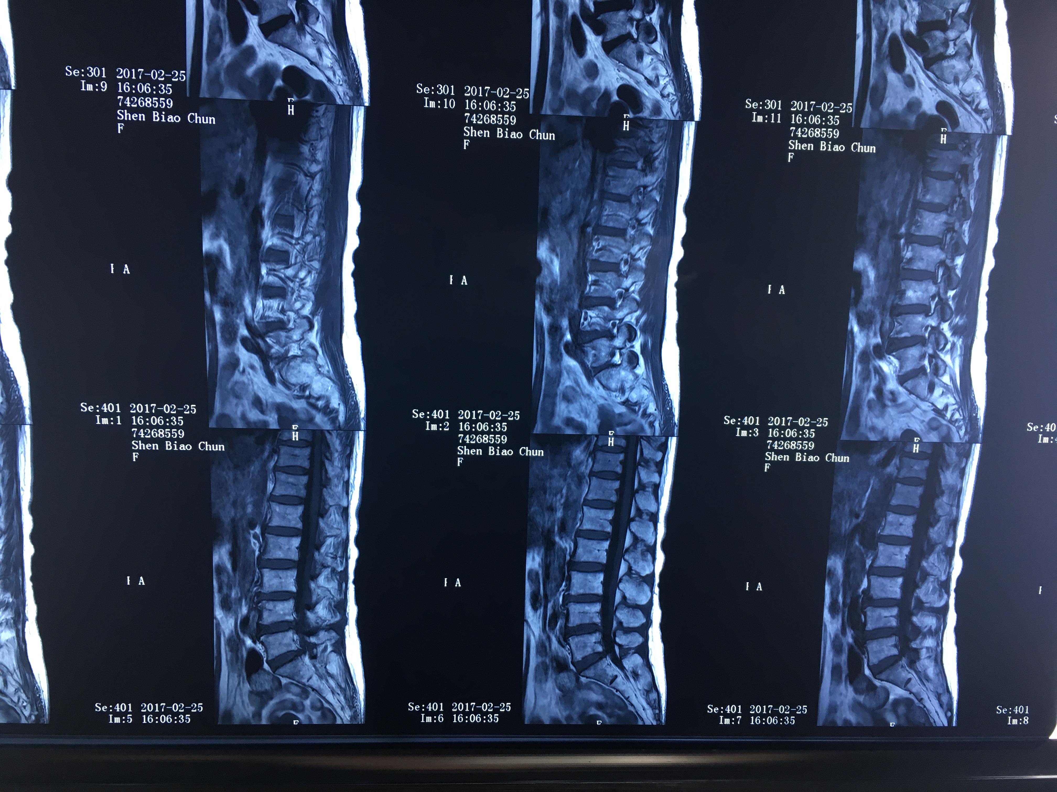 腰椎间盘突出症患者疑问：纤维环破裂后，还能不能自我修复好？__中国医疗