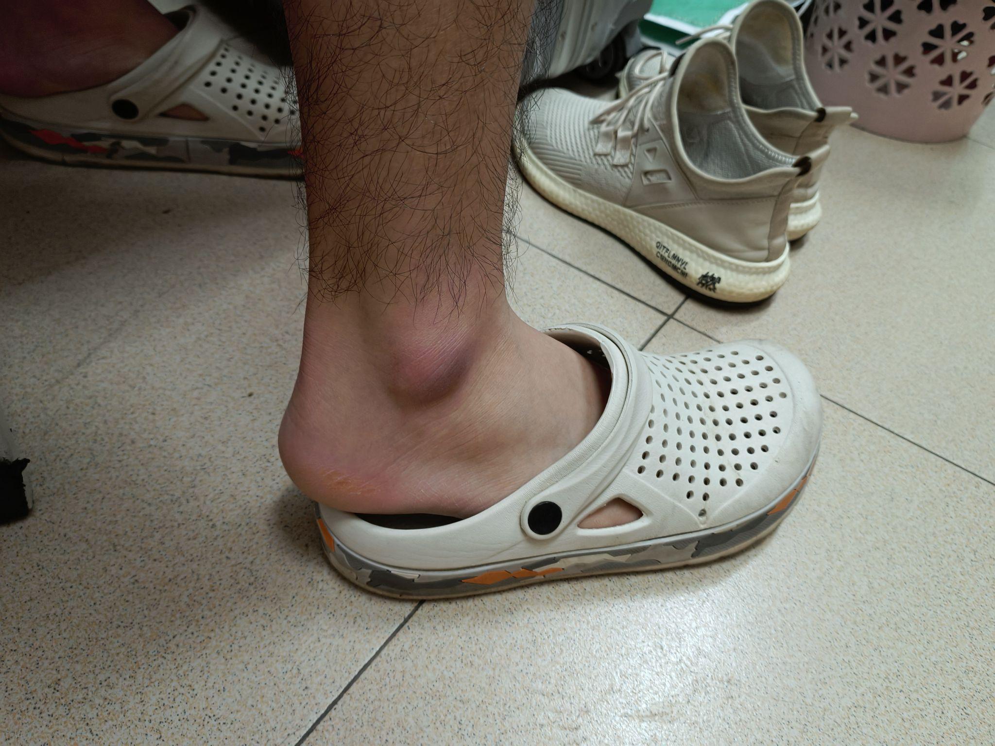 脚踝边上骨头凸起的地方皮肤黑. - 知乎