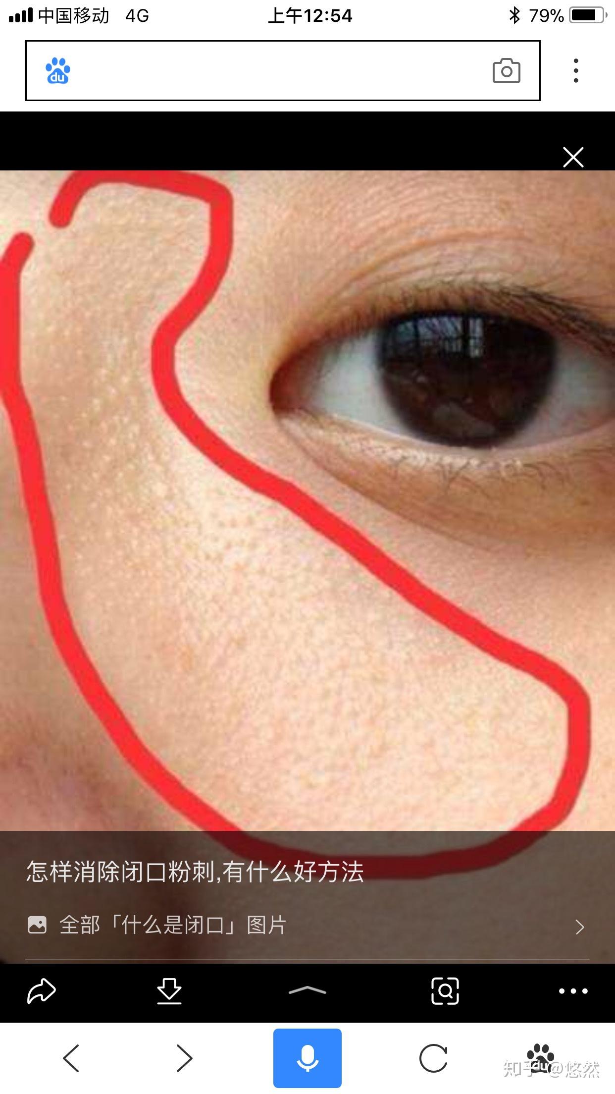 鼻子两侧小疙瘩不怎么大密密麻麻的是什么