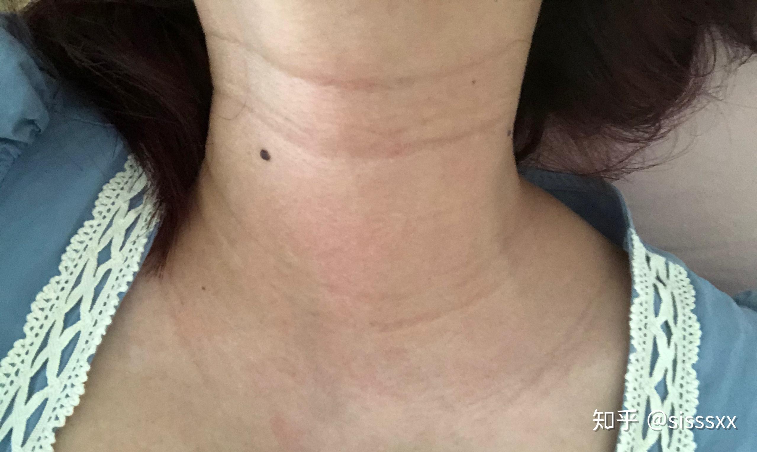 15岁颈纹很深怎么办啊,真的三条很明显的线,锁骨下面也有一条,我哭了?