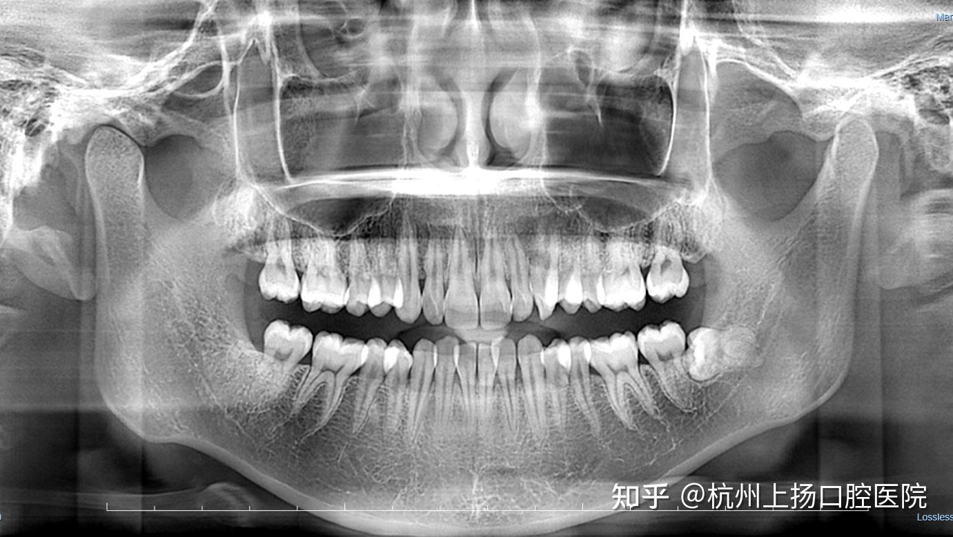 正规的口腔机构,一般都要拍全景片,照面相,拍x光定位片,检查全口牙齿