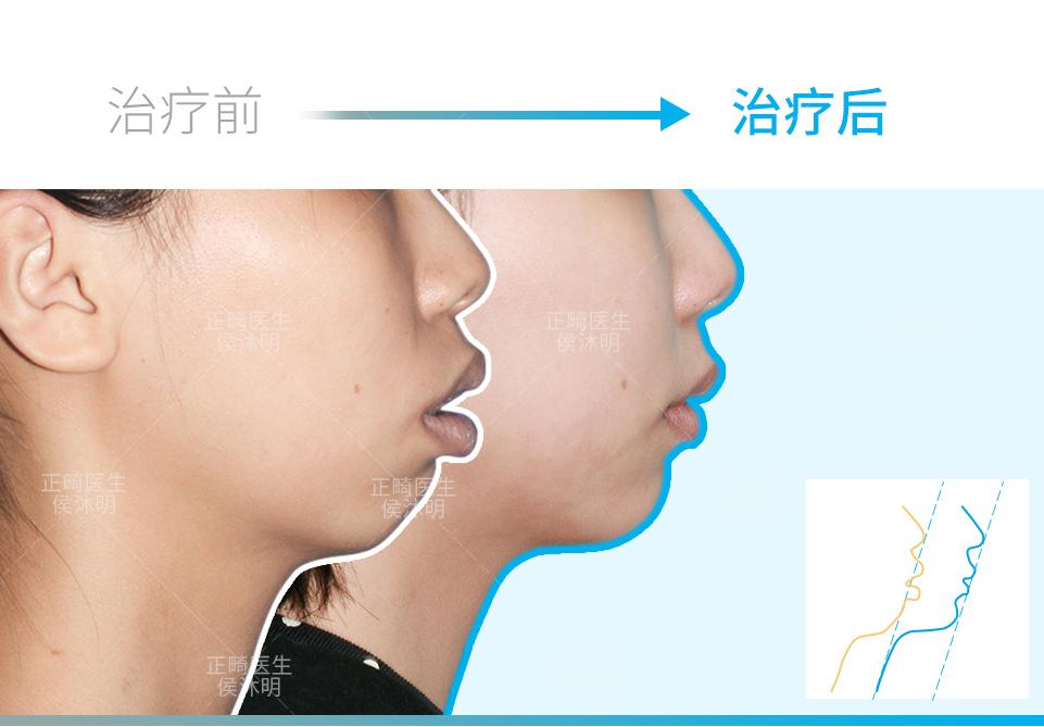 成人骨性下颌后缩伴开颌矫正案例