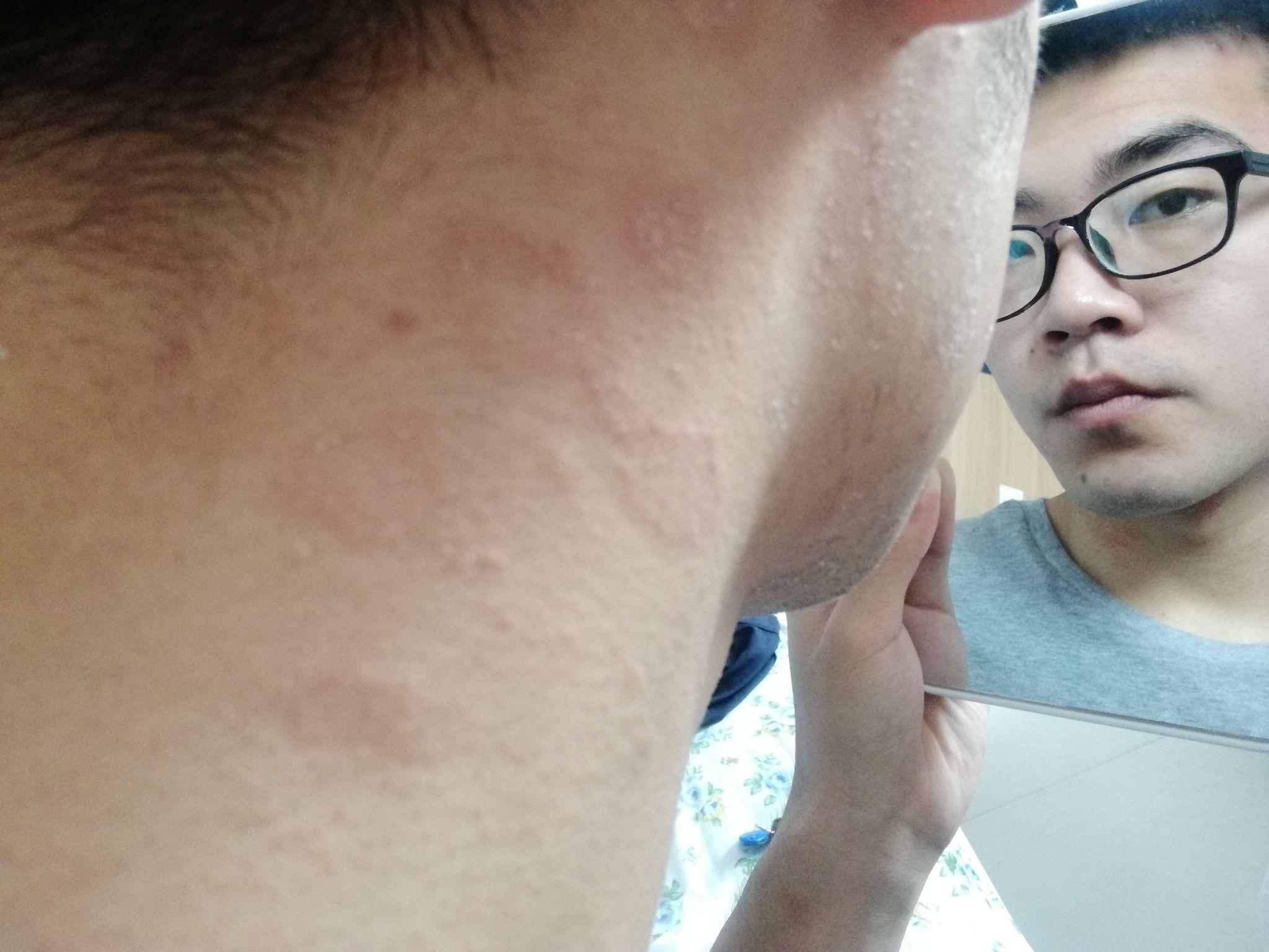 得了玫瑰糠疹怎么办