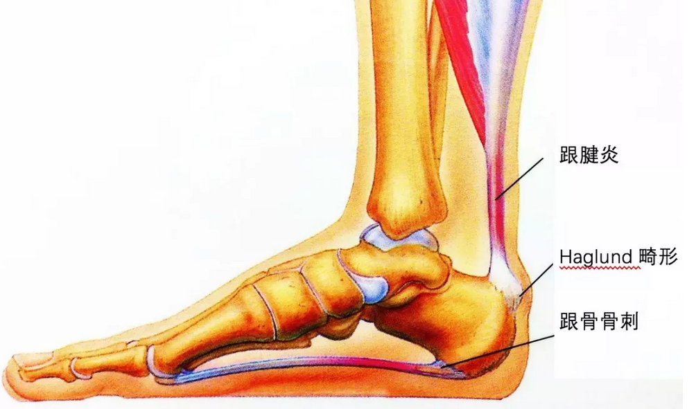 一文带你了解足跟痛 知乎