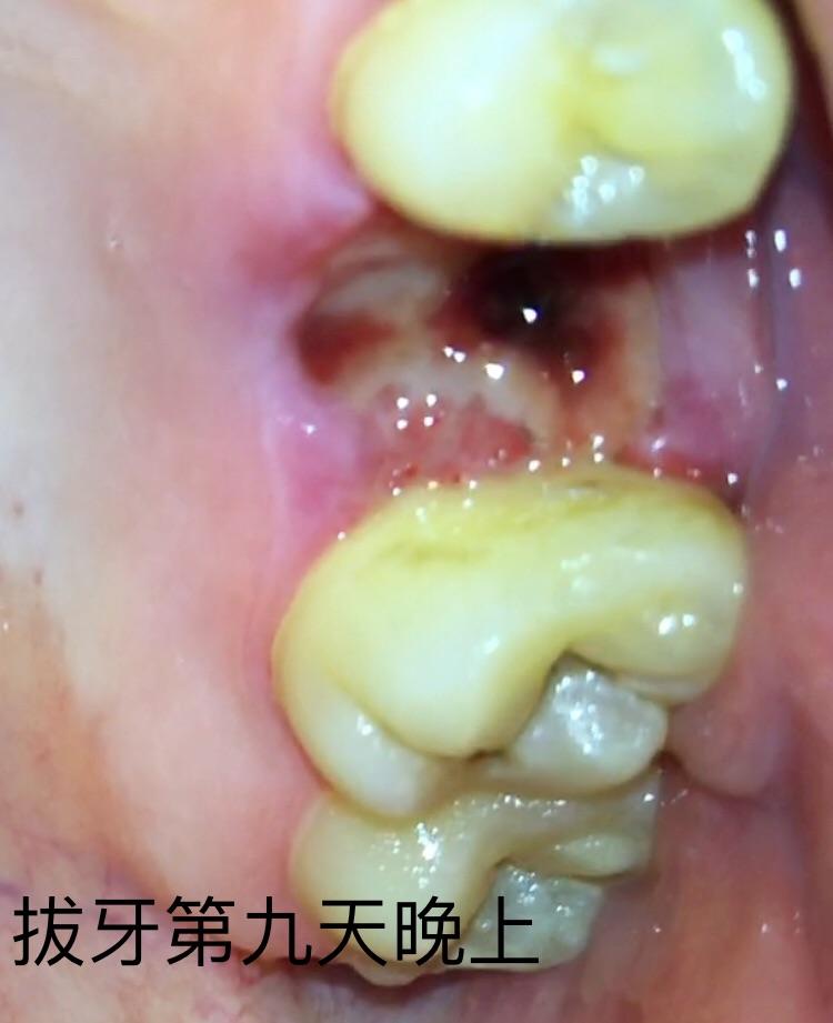 拔牙牙洞恢复过程图解图片