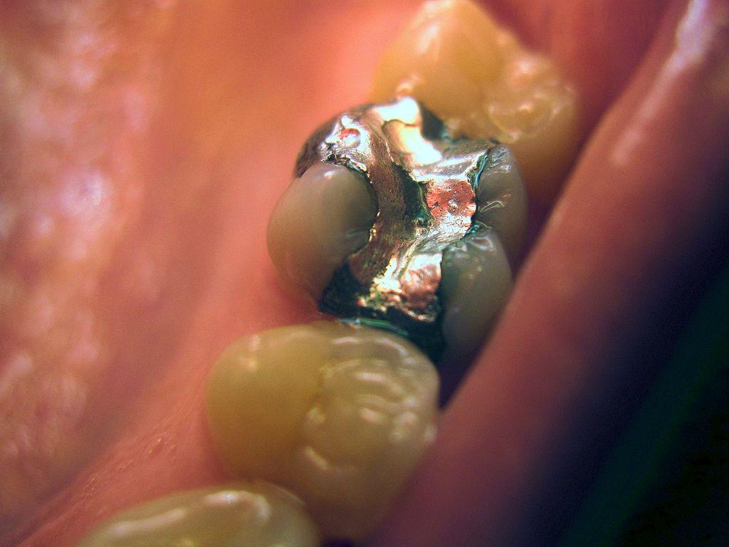 汞合金(牙科 amalgam(dentistry)