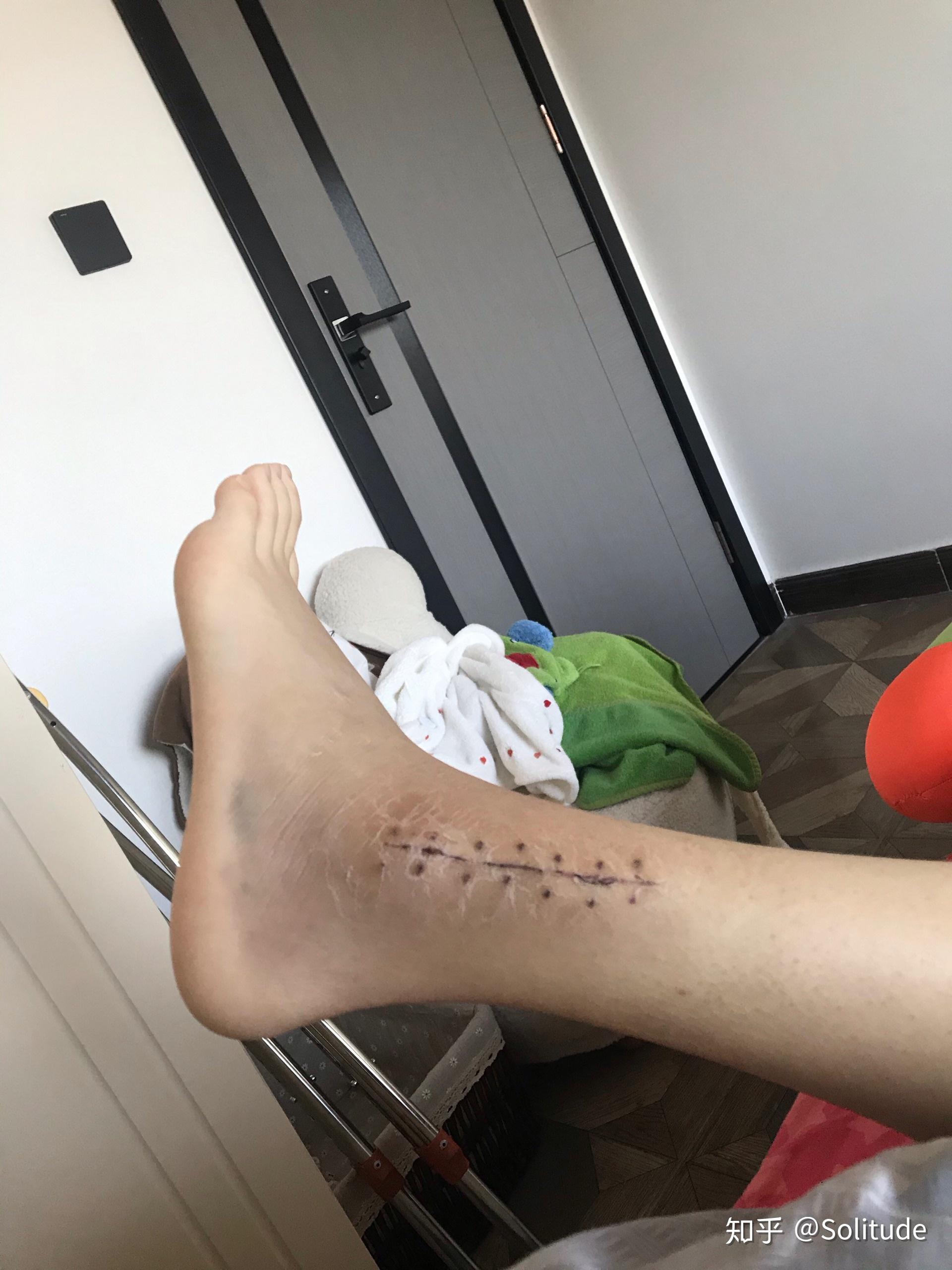 崴一脚骨折的可能性大么?