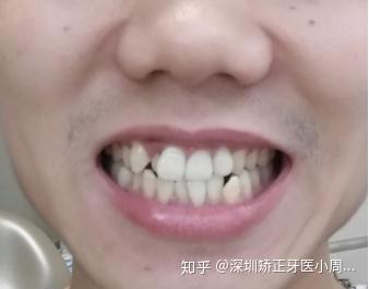 牙齿小的男人性格特点 v2-59fbc14d6b71e6447a6d5471167cb98c_b.jpg