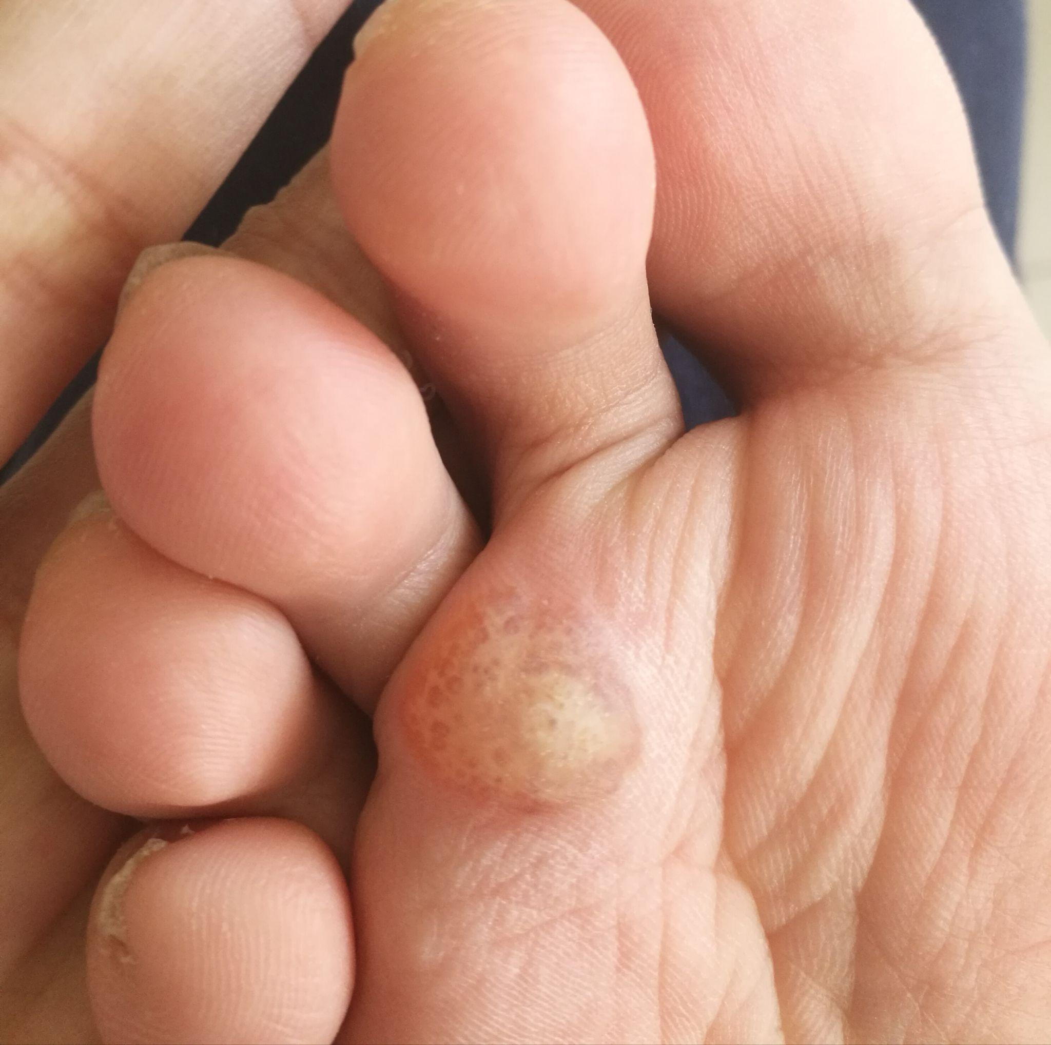 脚上跖疣涂了阿昔洛韦乳膏后,涨起来,变大,感觉里面有液体 ,请问是快