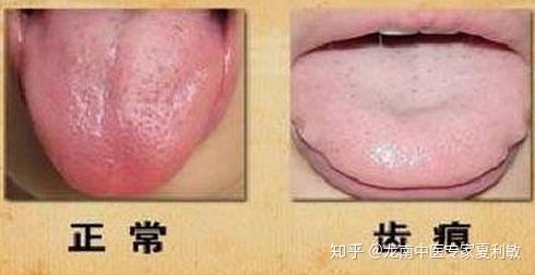 舌头上出现了齿痕，这是怎么回事？ - 知乎