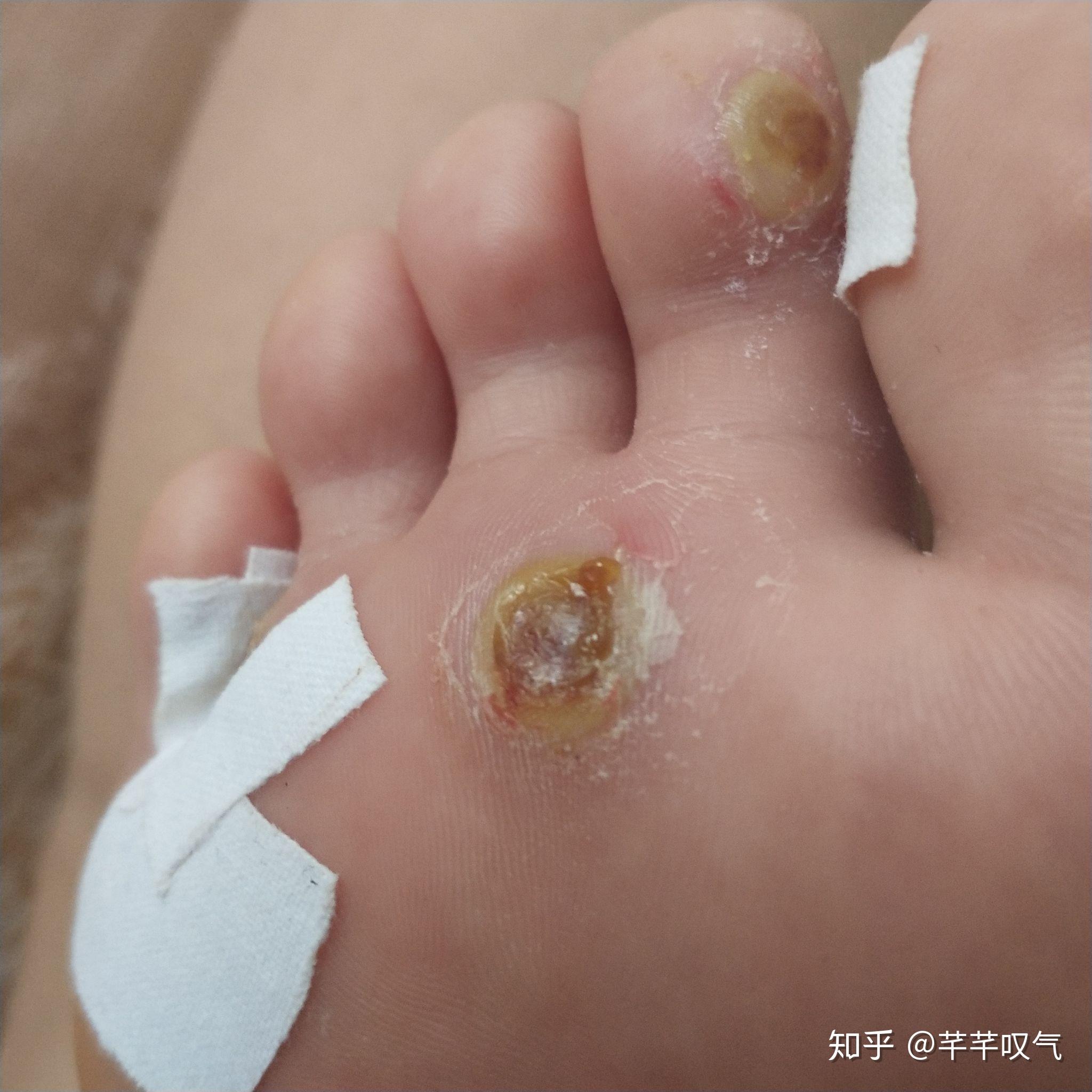 鸦胆子治疣的方法 zhuanlan.zhihu.com