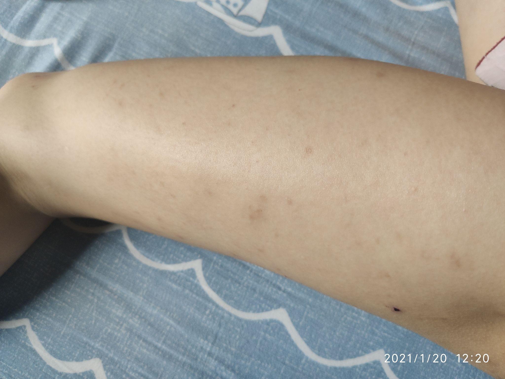 腿上有大面积的红色疹子 瘙痒 复发性强 看看有什么解决办法 有图片_百度知道