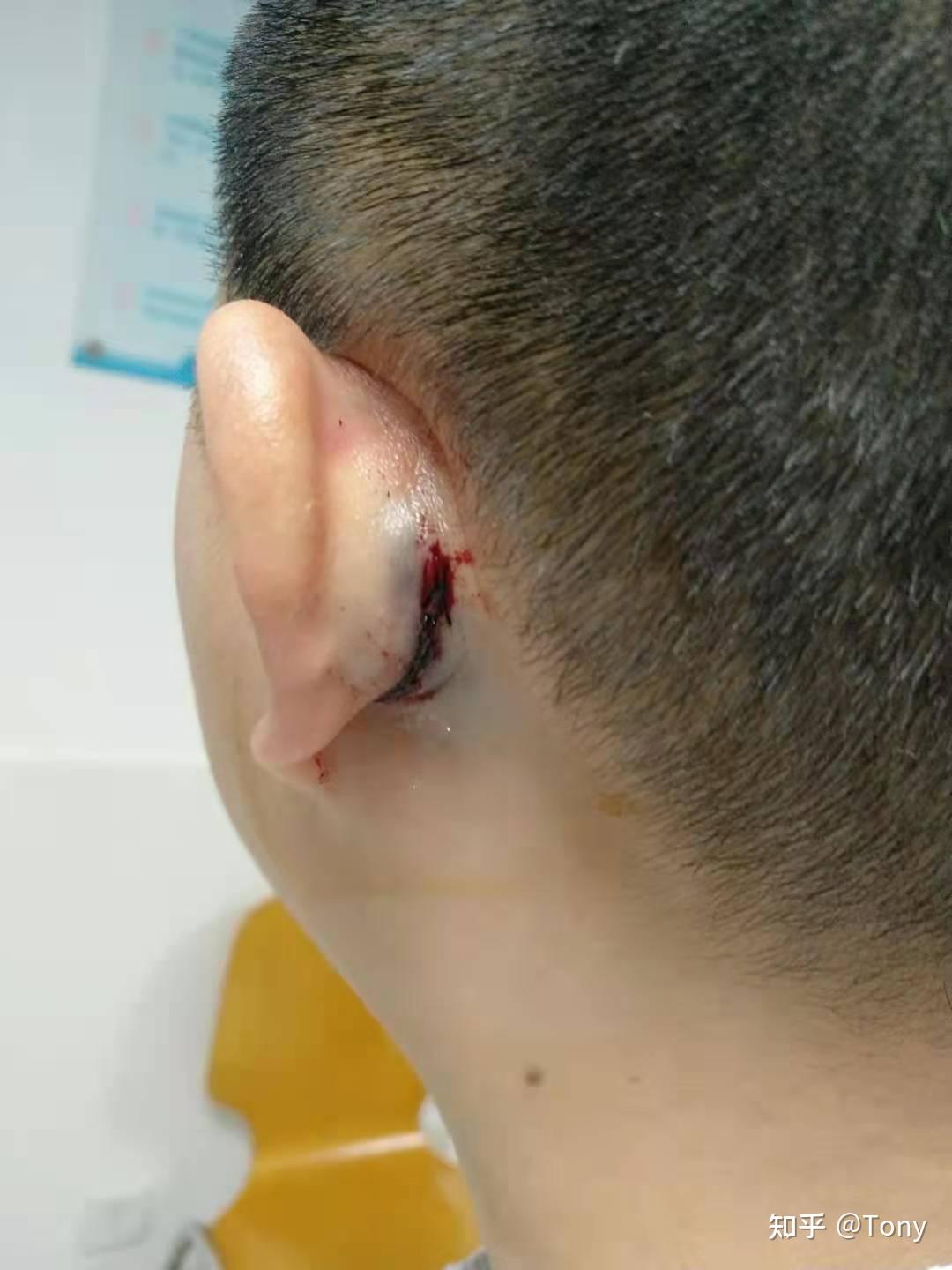 双耳大穿孔我的耳膜修补手术2020年10月9日右耳手术成功11月27日左耳