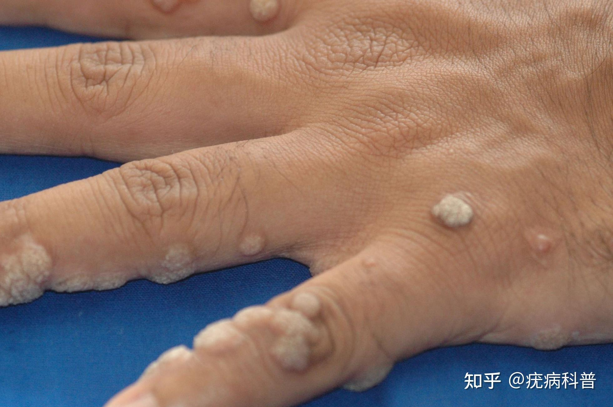 麻烦大家看下,这个是寻常疣吗? - 知乎