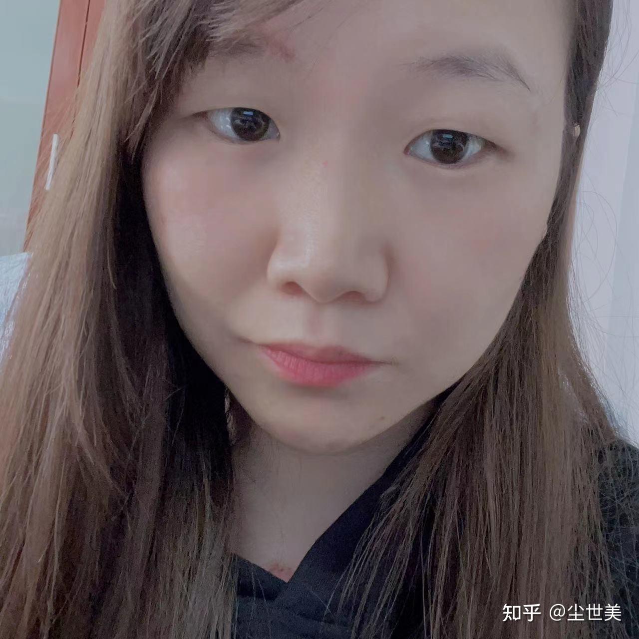 才能拆线,拆线第五天图(苹果原相机拍摄)11,拆线一周后,一直在使用舒