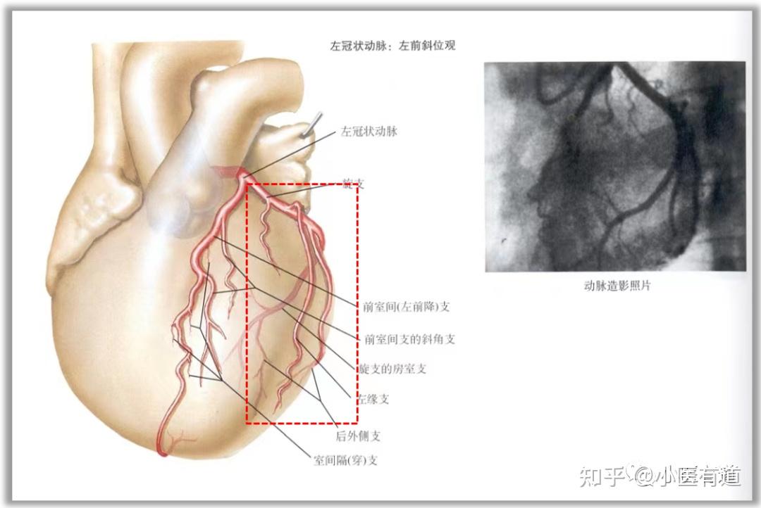 回旋支om图片