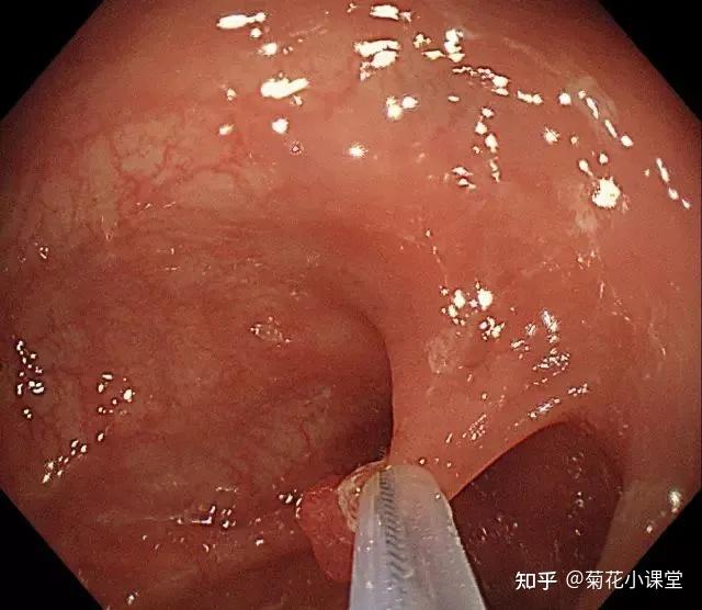 步骤五:在钢丝圈上脉冲式通高频电进行电灼烧,直至息肉根部被切断