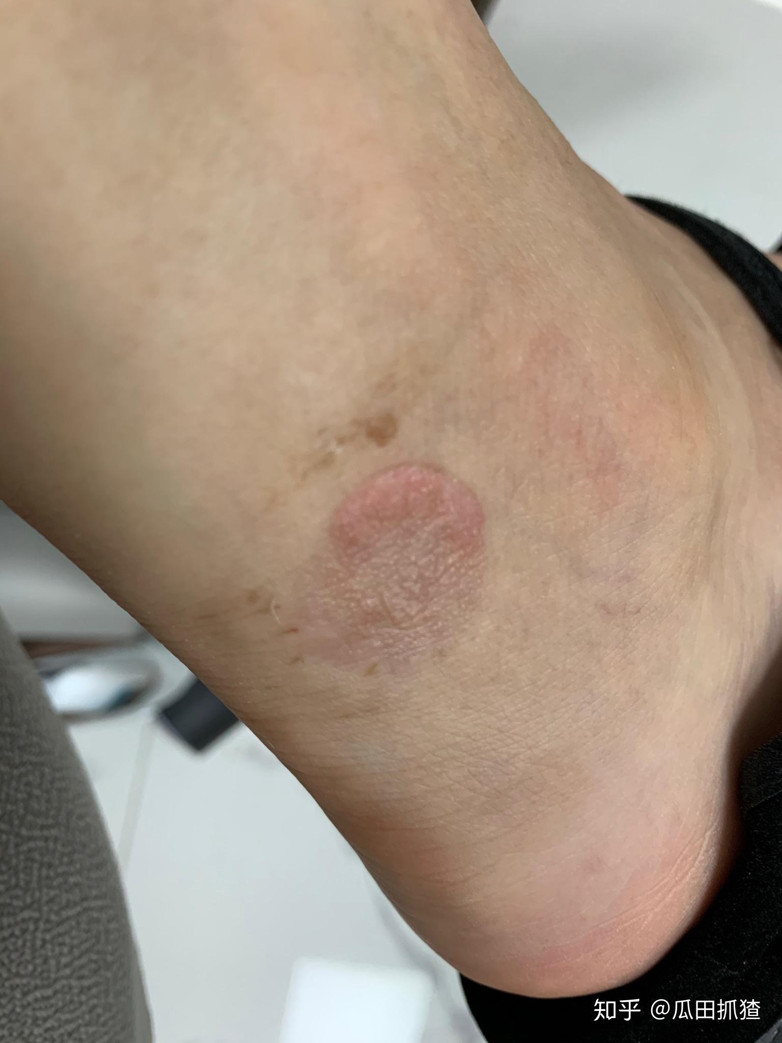 被隐翅虫咬了会怎么样