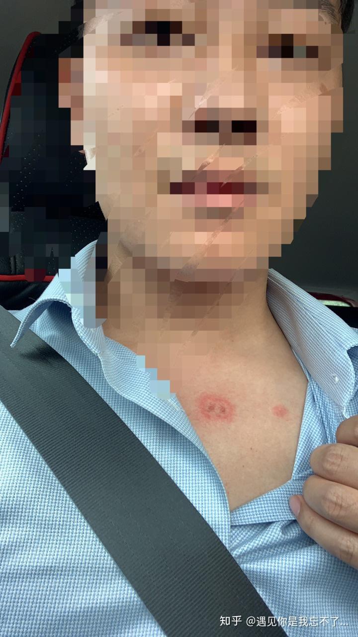 人得了猫癣发痒怎么办