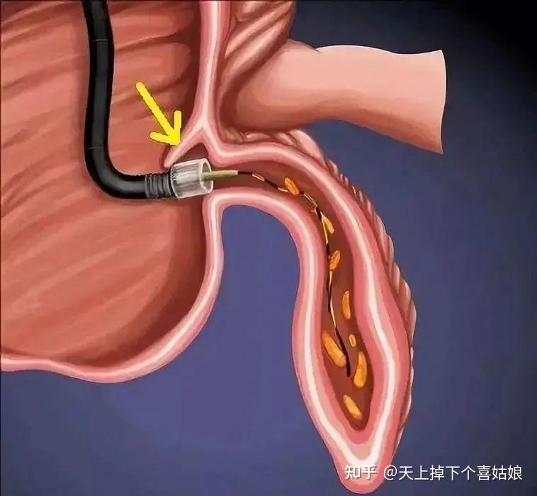 简单来说,就是做肠镜时,在内镜前端套上一个透明帽,在透明帽的帮助下