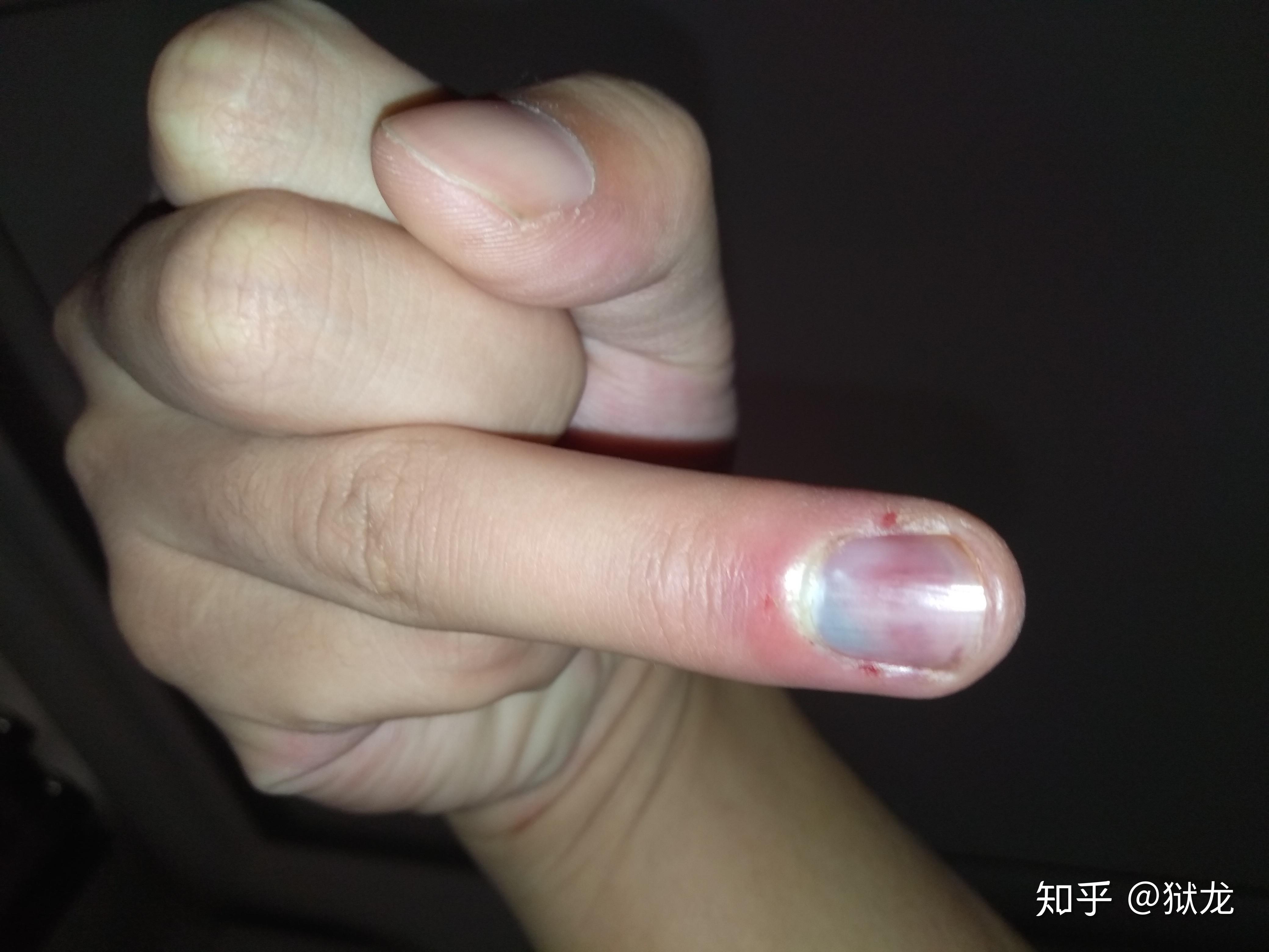 手指甲被夹到,过了一段时间,有黑色的淤血,怎么处理? - 知乎