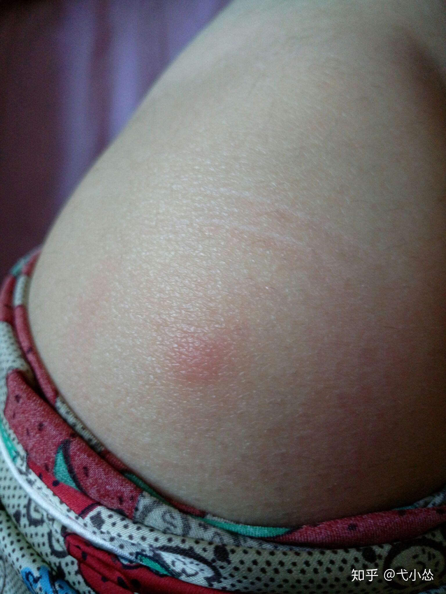 被跳蚤咬了怎么办