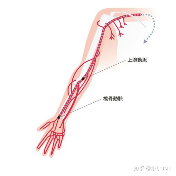 Jmt独家 日本心绞痛 心肌梗死治疗方案汇总 知乎