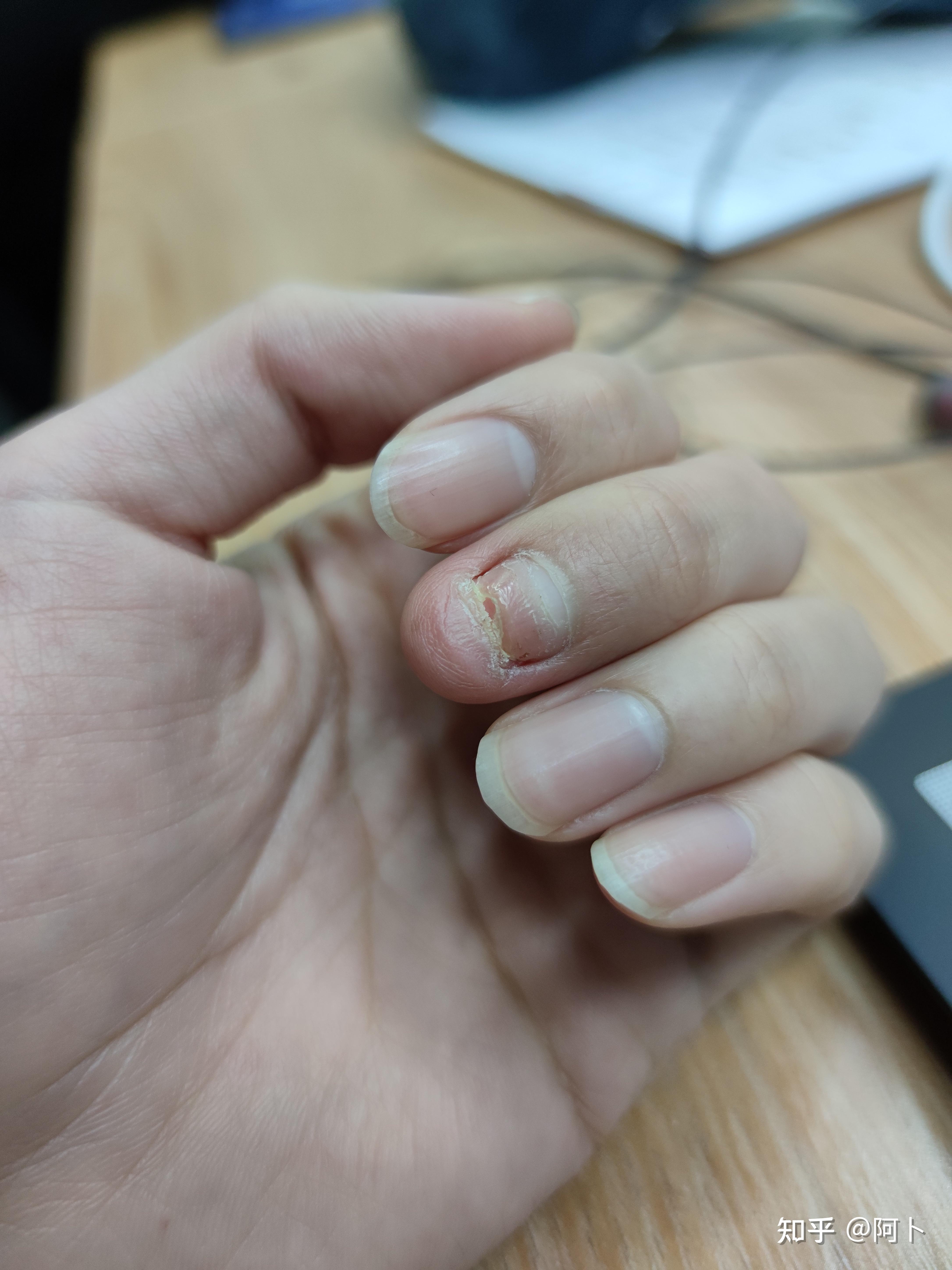 指甲完全没了重新长是什么感觉