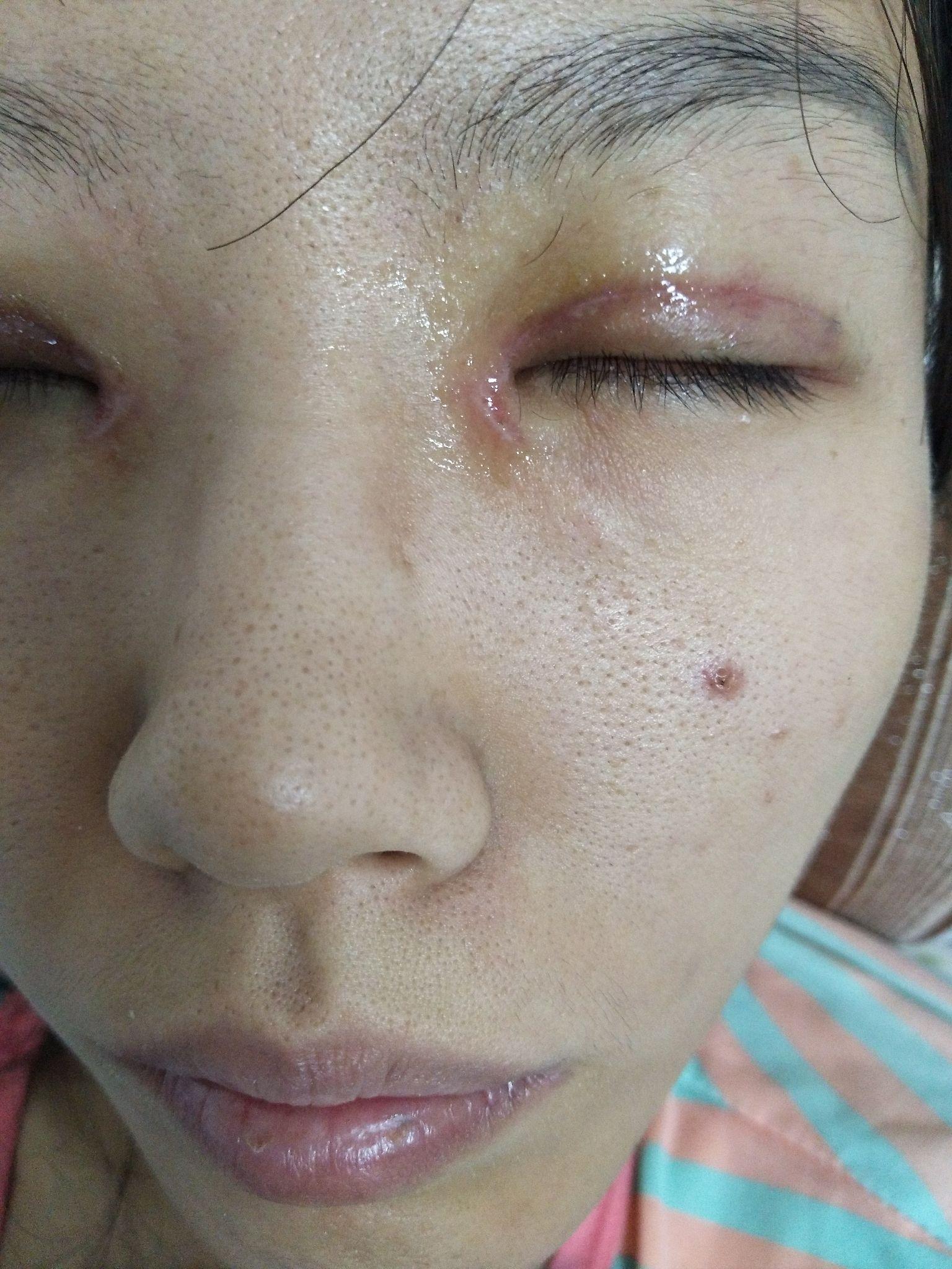 请问下这个双眼皮恢复怎样会留疤吗睁眼紧绷感