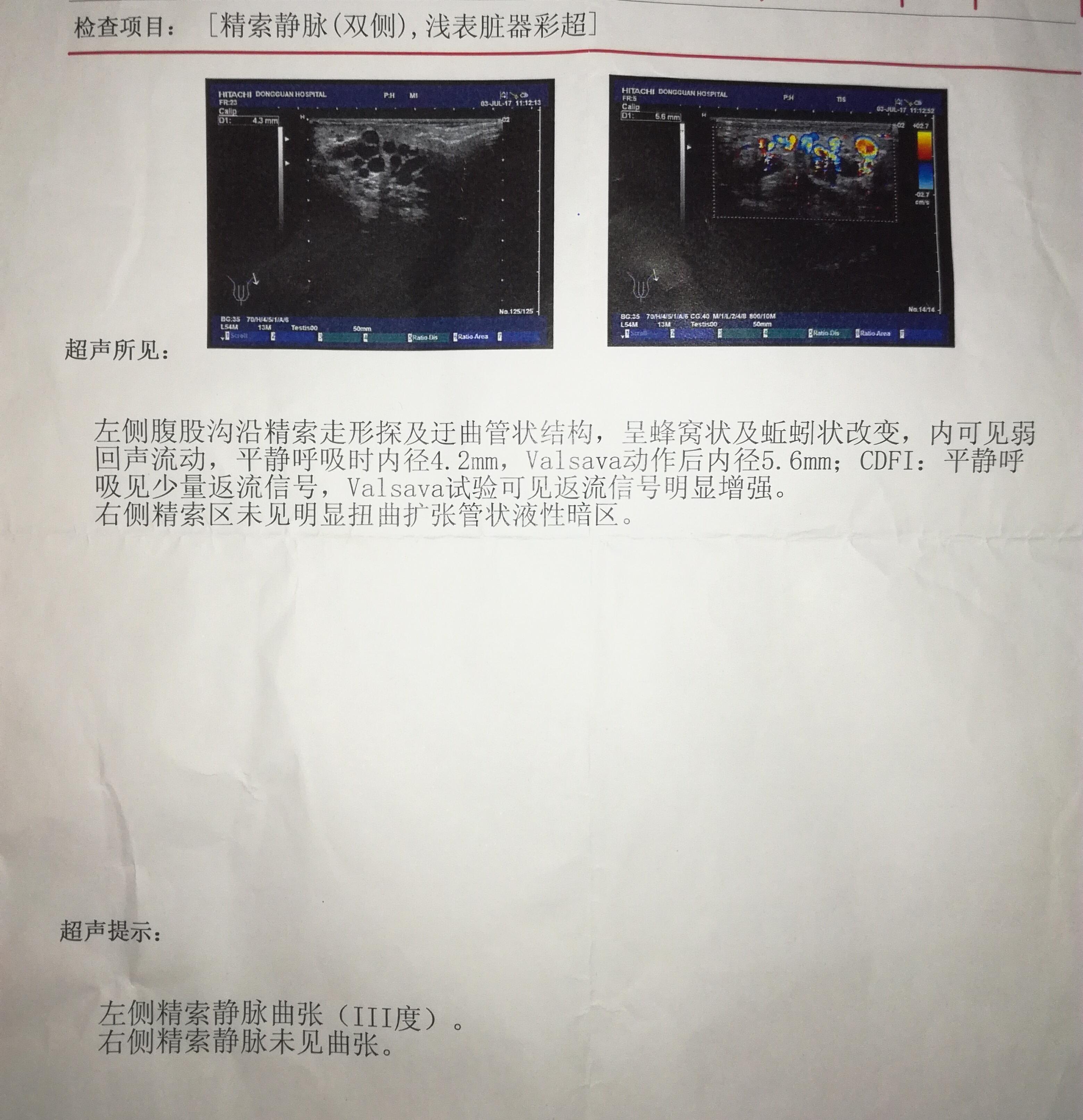 精索静脉曲张怎么办? - 知乎