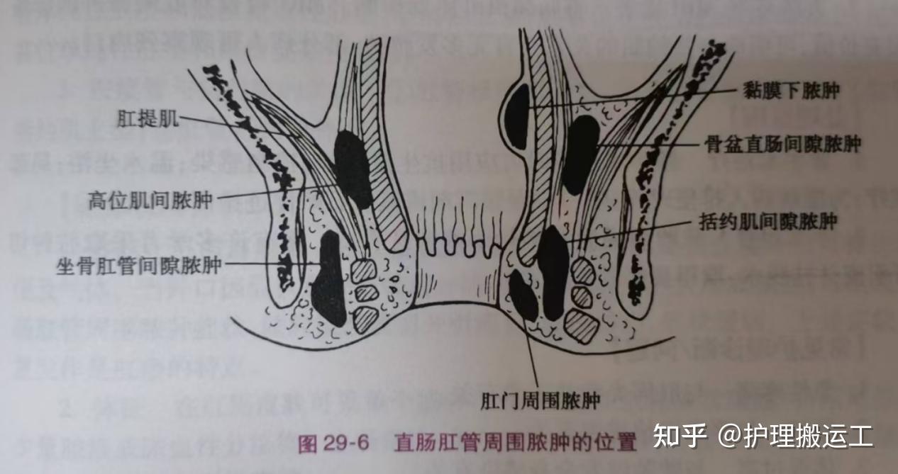 直肠肛管周围脓肿