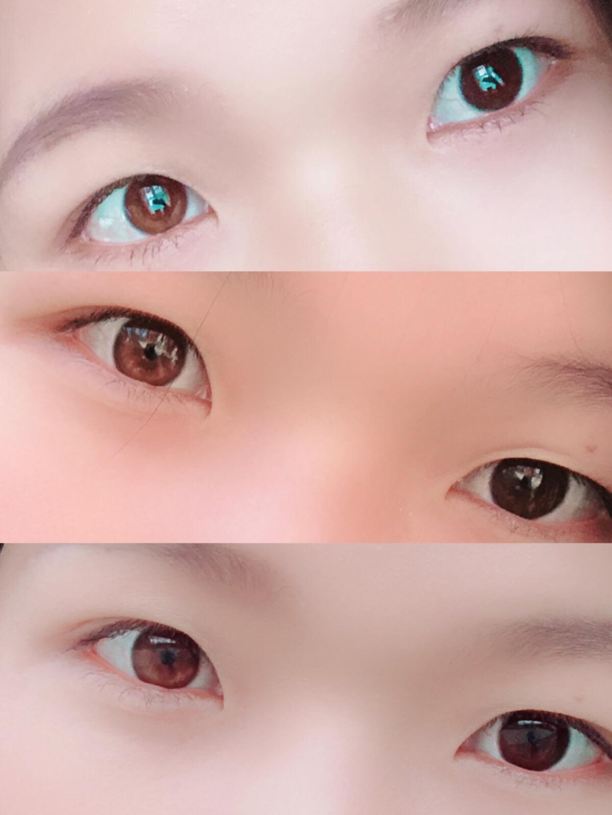 虹膜异色症是种怎样的体验